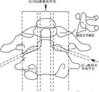 寰齒關節錯位型頸椎病_韌帶_前弓_相關