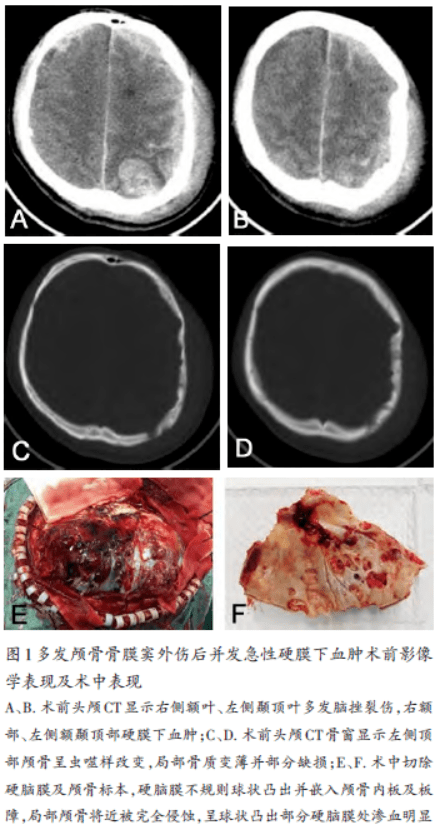 骨膜下血肿图片