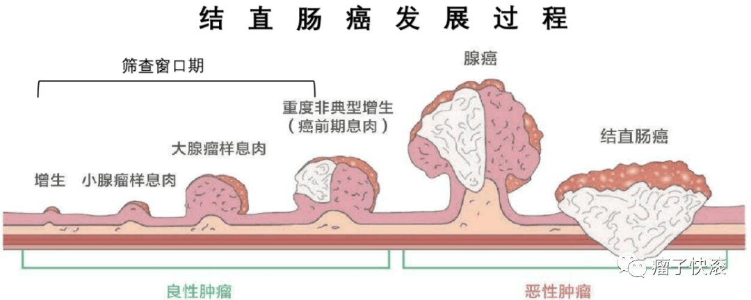 结直肠癌靶向治疗要做哪些基因检测