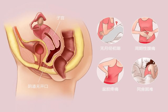 微創yin道再造術重塑女兒身!_陰道_子宮_月經