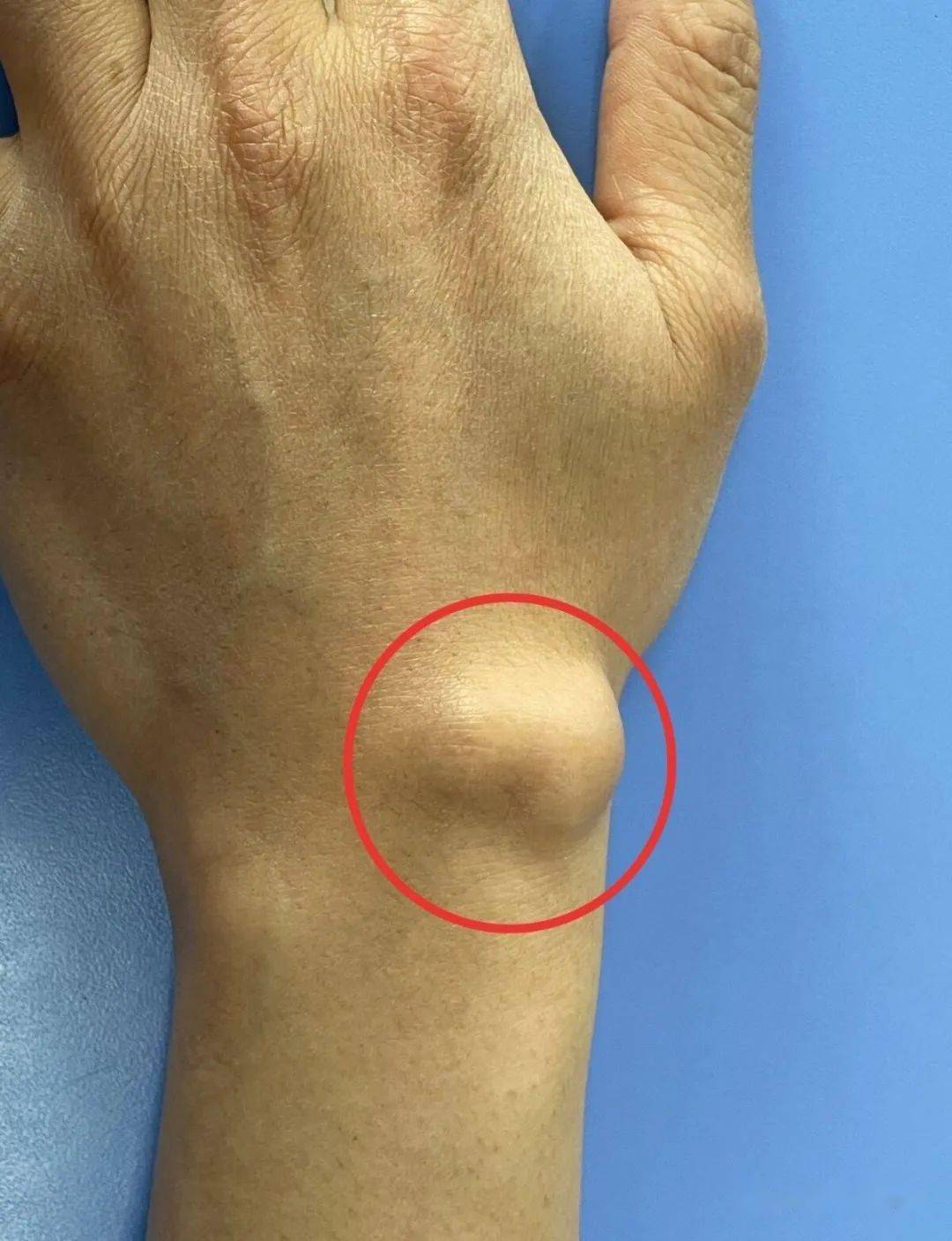 手和手臂为什么疼?11种相关疾病来解答_症状_关节炎_桡骨