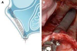 動態導航技術在穿顴種植手術的應用_顴骨_患者_進行