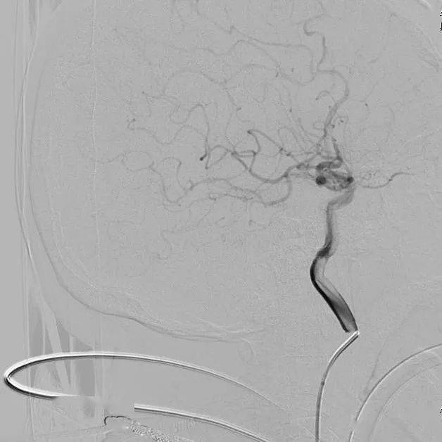 中國神介500人群病例集錦第227期:大腦前動脈取栓3例_造影_症狀_導管