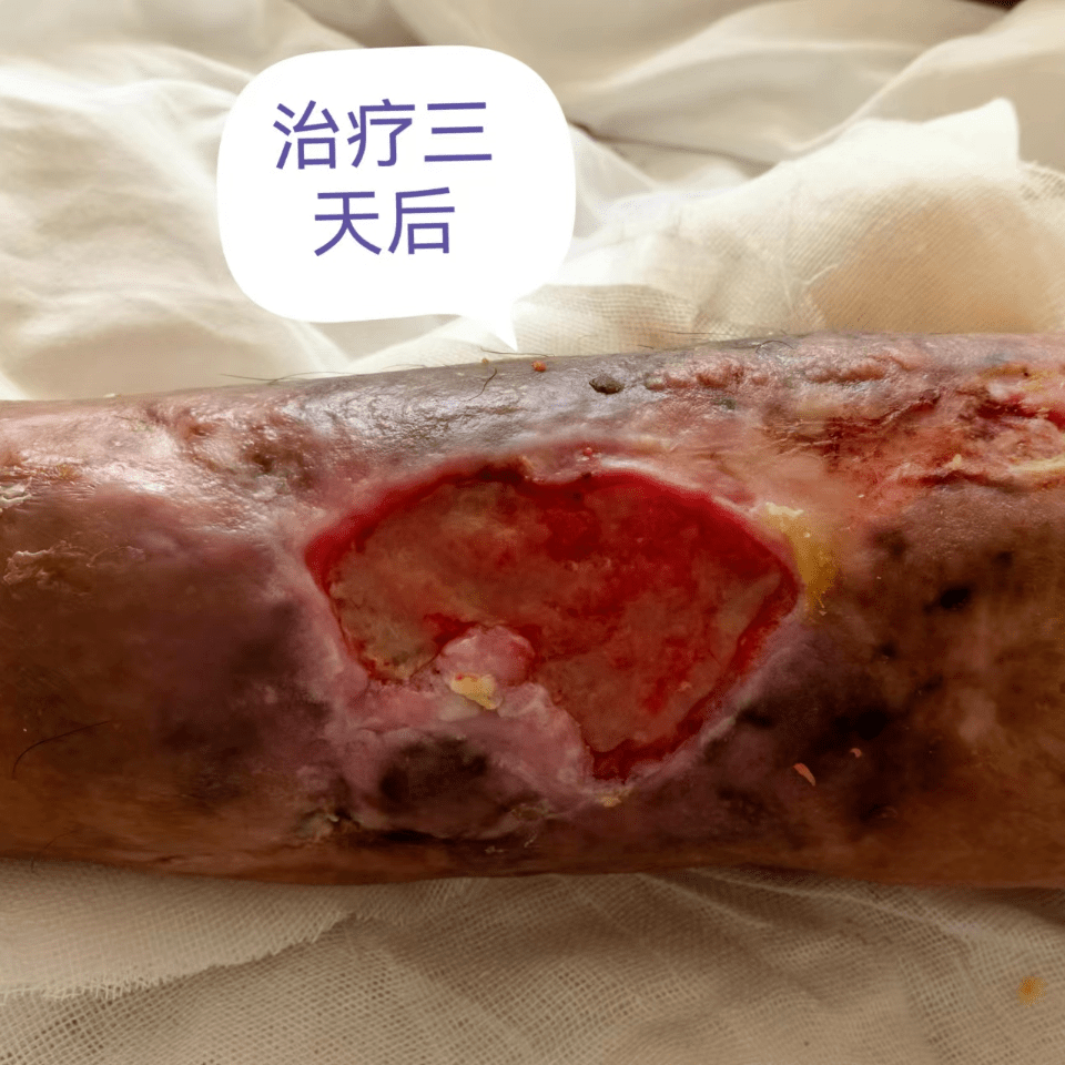 【平医救治故事】二十年的"老烂腿" 妙手治顽疾_创面_患者_治疗