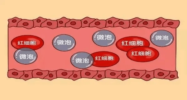 六氟化硫微泡造影剂图片