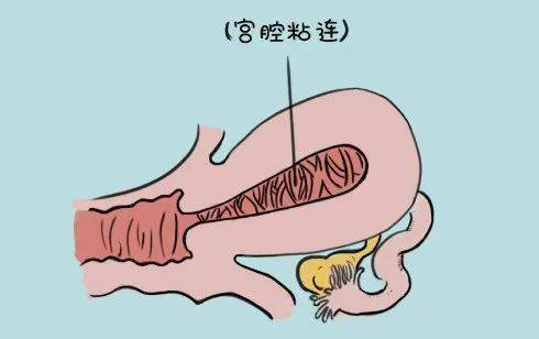 "粘"之深,痛之切,遭遇备孕拦路虎"宫腔粘连",如何绝处逢生?