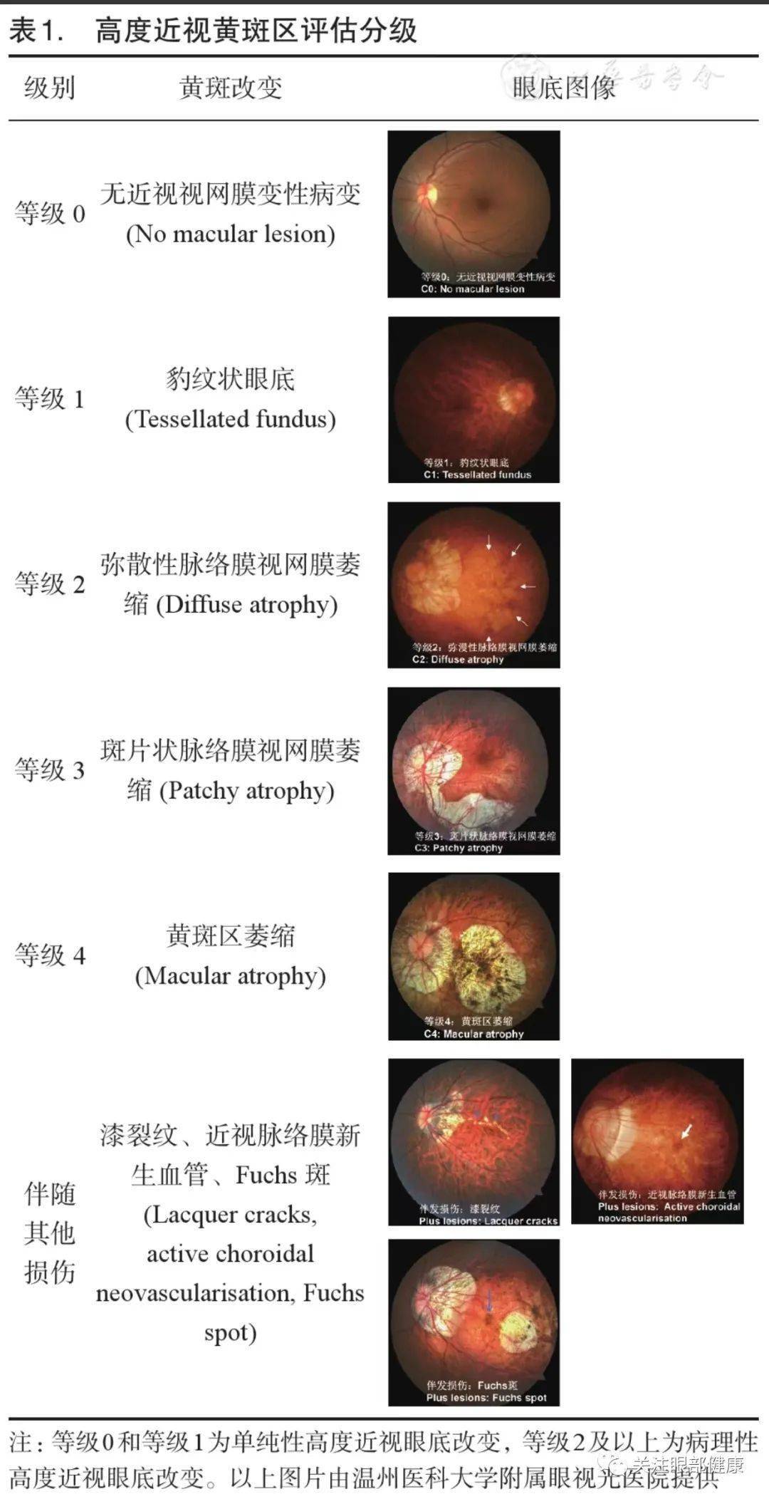 眼底照相正常图片解读图片