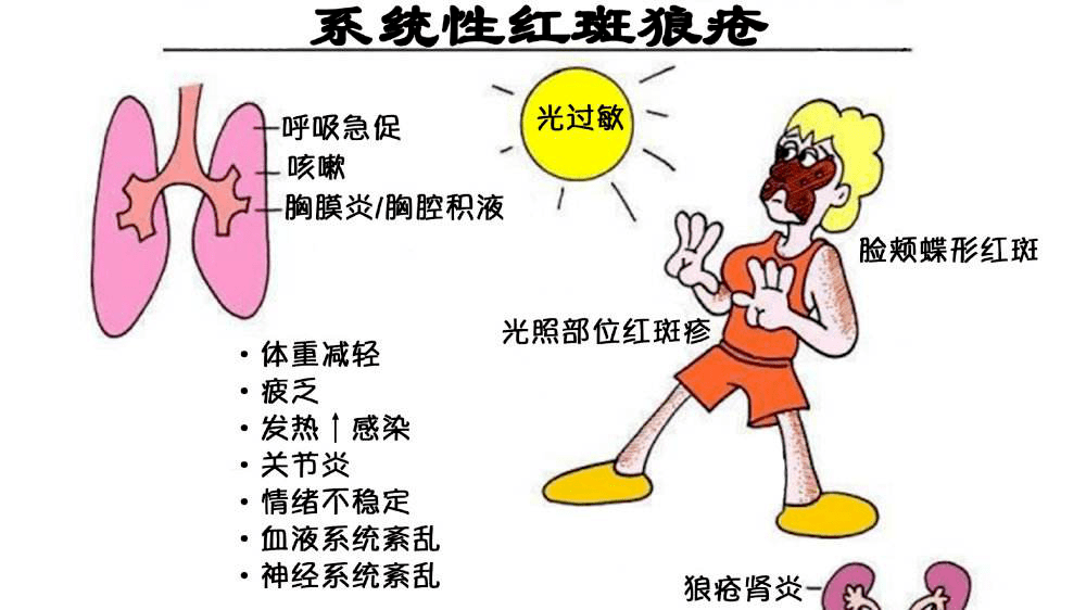【健康科普】没有红斑就不是系统性红斑狼疮吗?_患者_病变_免疫