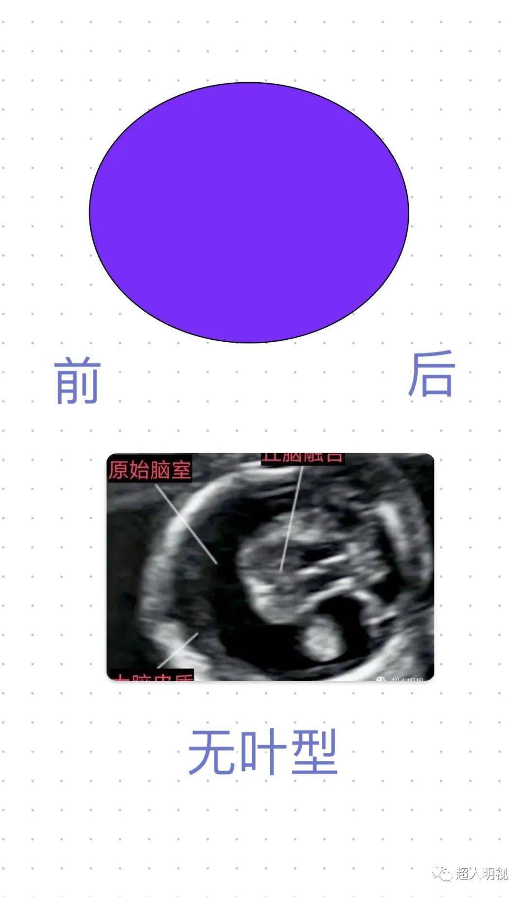 胎儿叶状全前脑误诊图片