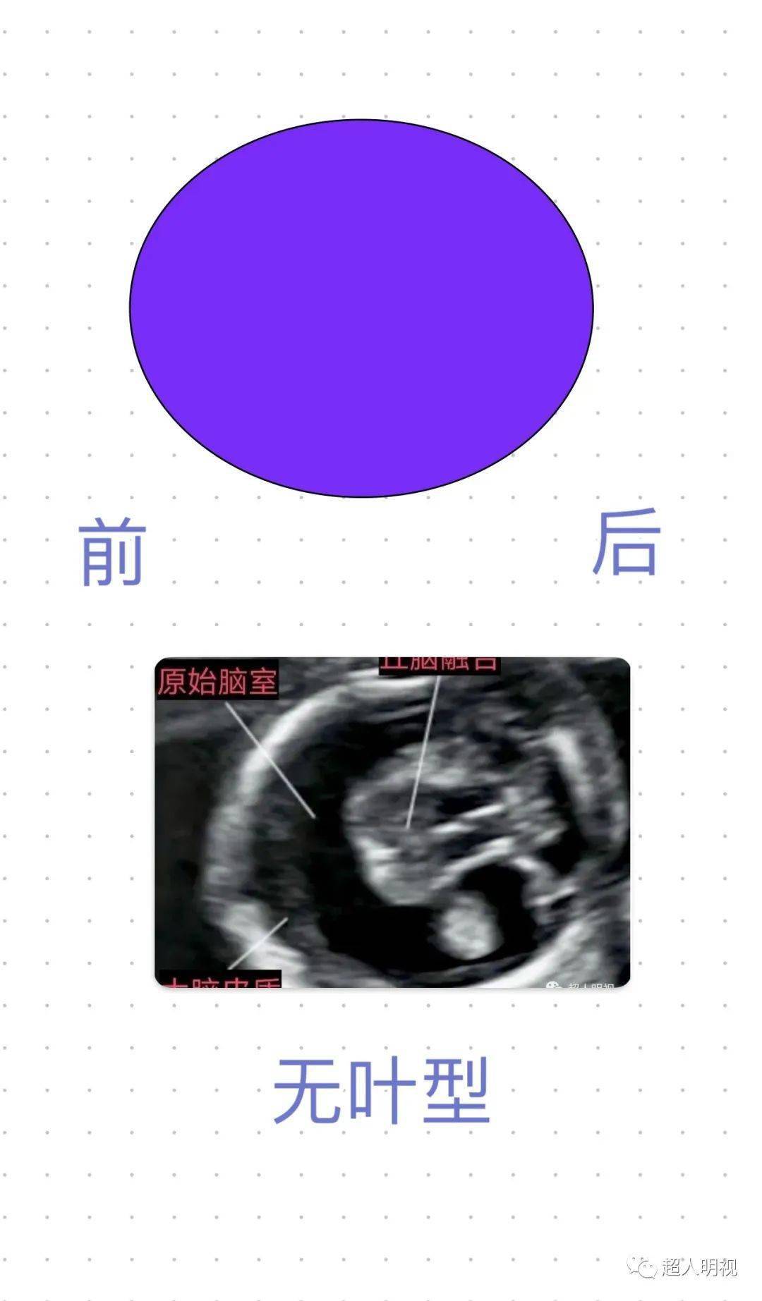 下面看前脑无裂畸形(全前脑)声像图先看正常孩子对于超声医师而言,分