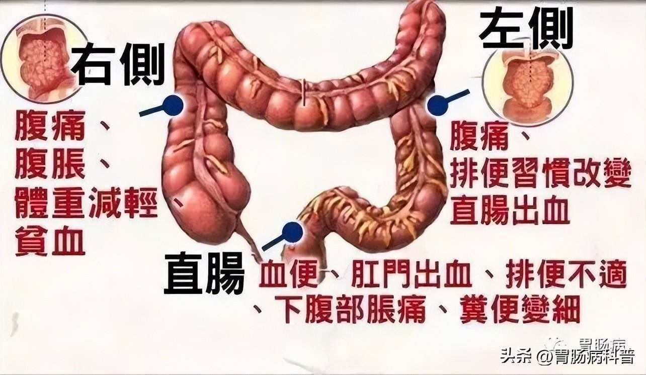 由于大肠癌的肿瘤溃烂失血和毒素吸收,常可导致结肠癌患者出现贫血