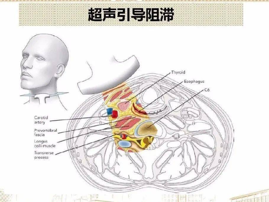 超聲引導下星狀神經節阻滯治療_交感神經_視頻_全屏