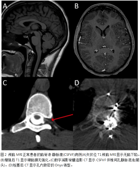 治療後,4例硬腦膜強化,7例靜脈竇充血,19例鞍上池消失,0例硬膜下積液