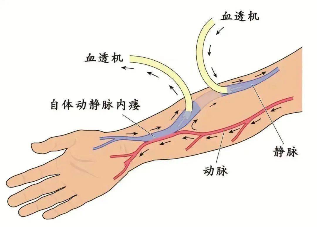 动静脉内瘘 卡通图片