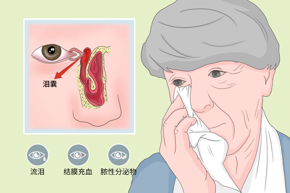 眼科｜得了泪囊慢性炎症，不妨给眼睛的“下水道”改个道_泪道_鼻腔_治疗