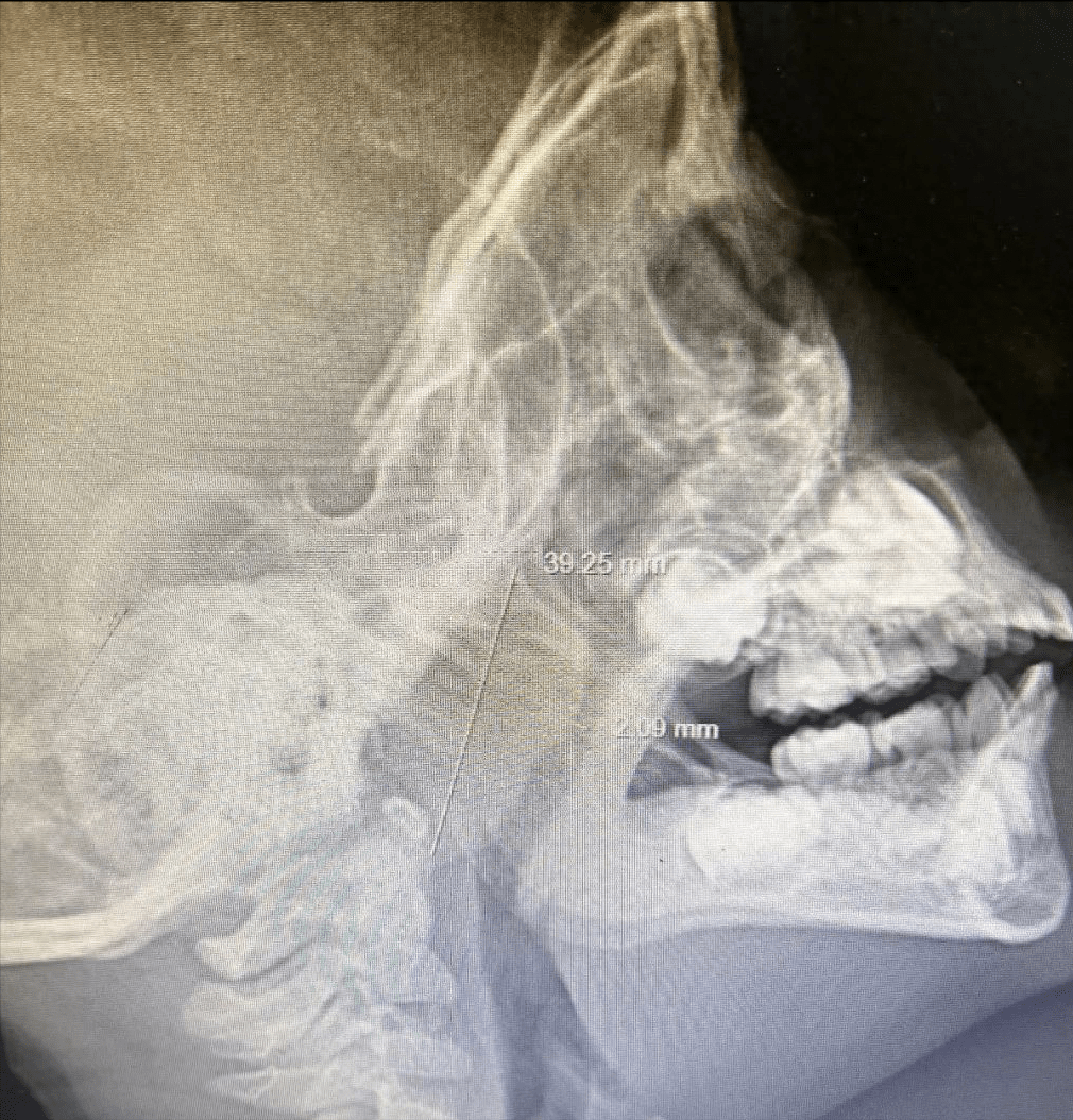 这种疾病比肺炎支原体肺炎严重的多,鲜有家长关注,今天我来谈谈