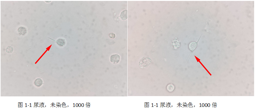 【尿液形態比賽】三等獎:尿液檢出尿酸鈉結晶病例分析_檢查_關節_病史