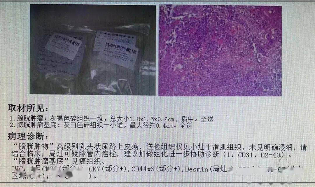 【病例分享】尿液細胞學檢出高級別乳頭狀尿路上皮癌_檢查_膀胱_形態