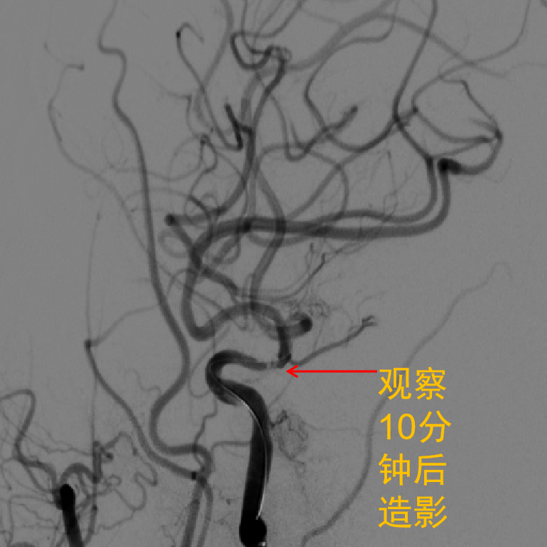 通橋·白駒過隙 銀蛇探囊|一例頸動脈閉塞急診血管