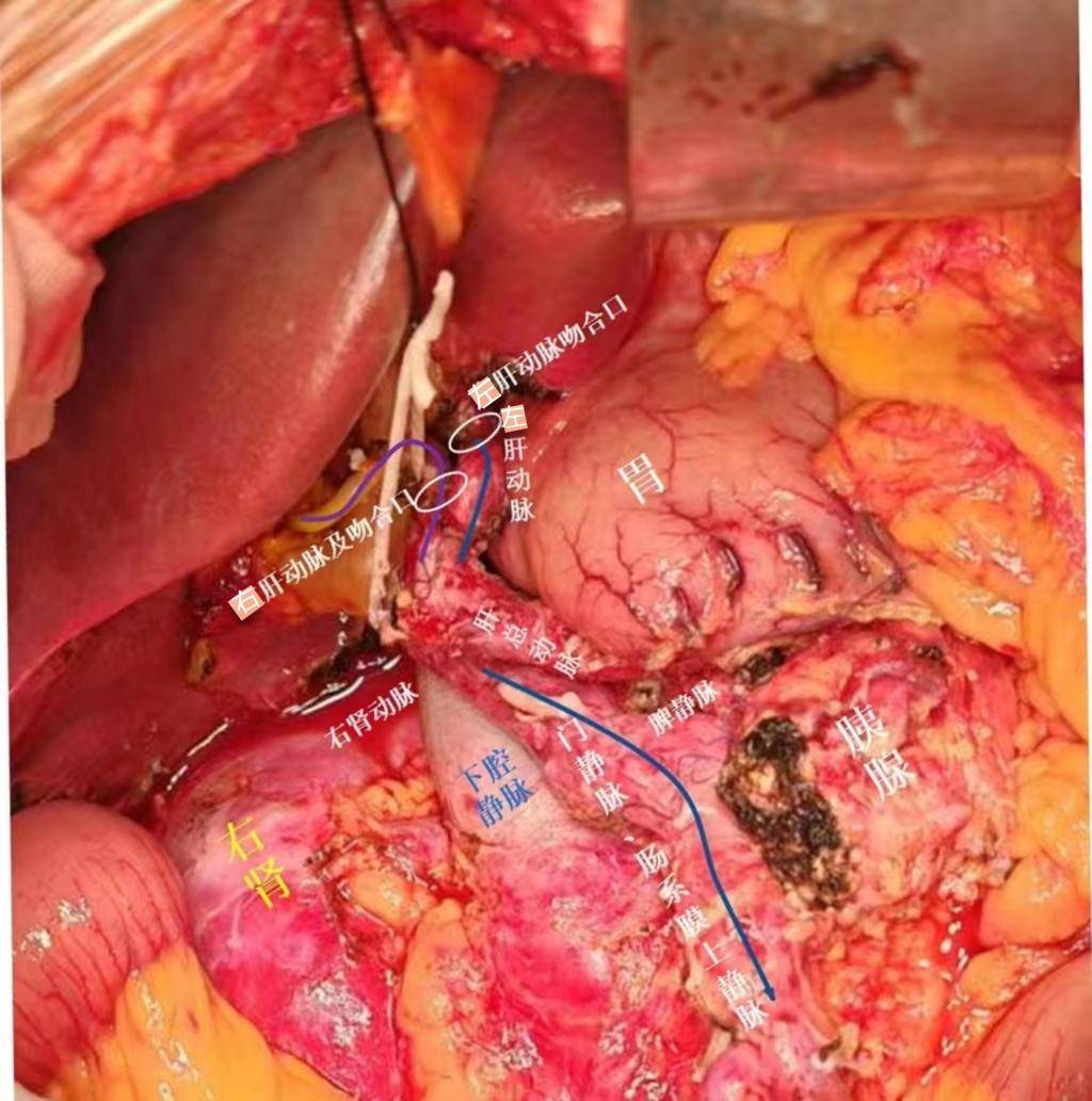 齐鲁医院普通外科李峰副教授成功实施高难度腹膜后肿瘤切除手术_患者