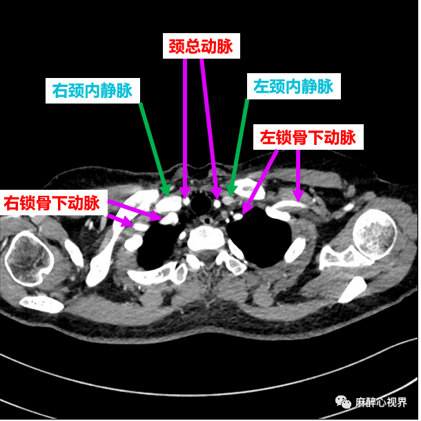 主動脈鈣化右肺動脈栓塞左肺動脈缺如和動脈導管未閉肺動脈擴張內容