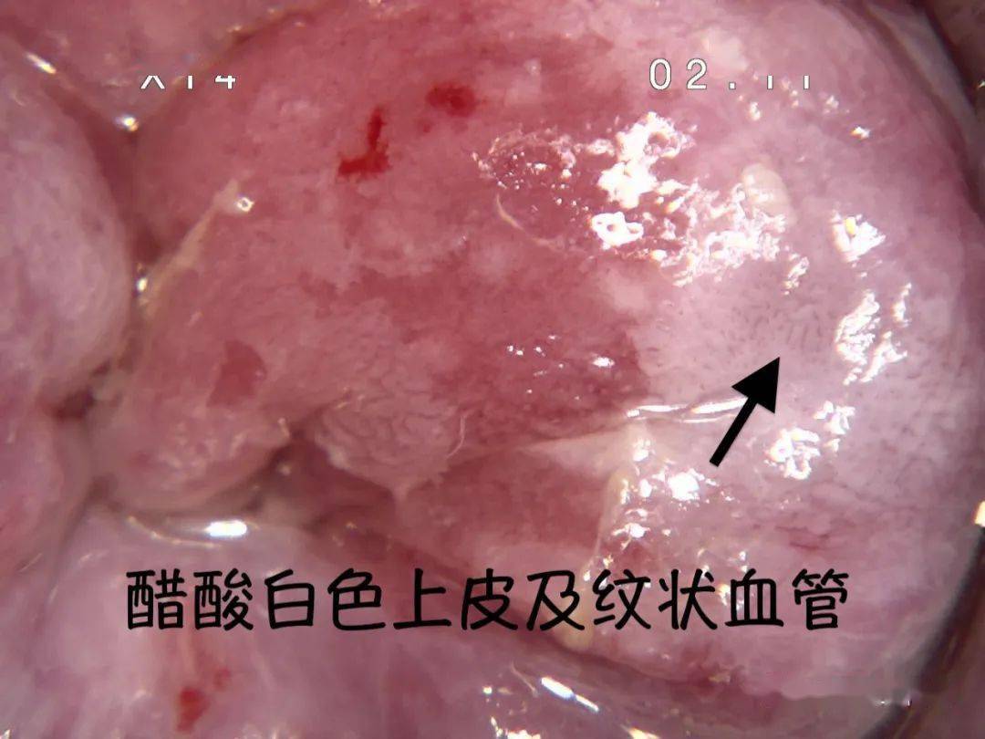 宫颈表面未见明显异常,阴道后穹窿及阴道后壁可见醋酸白色上皮,碘不