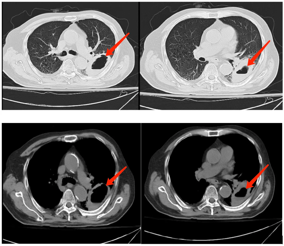 ct 影像显示肺部存在一个大厚壁空洞,大小 62*44mm,需要鉴别脓肿伴